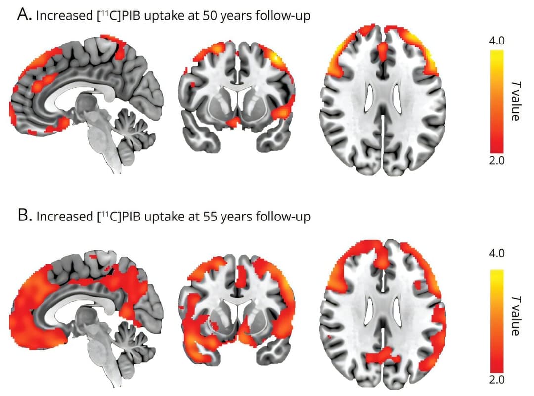 Childhood epilepsy may predispose patients to memory disorders later in life