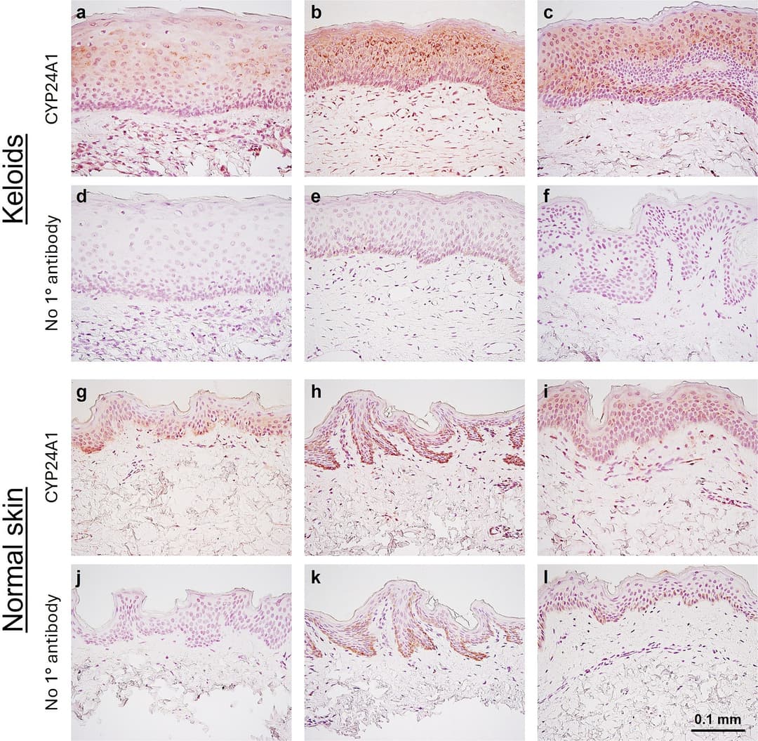 Vitamin D and keloid scars: Researchers find inhibiting enzyme could lead to treatment